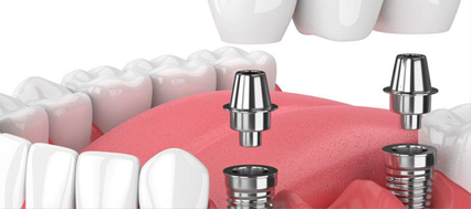 Dental Implants